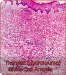 hydroxyurea sickle cell anemia
